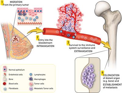 metastasis tumor extensive biomaterials frontiersin surgeons orthopedic innovative